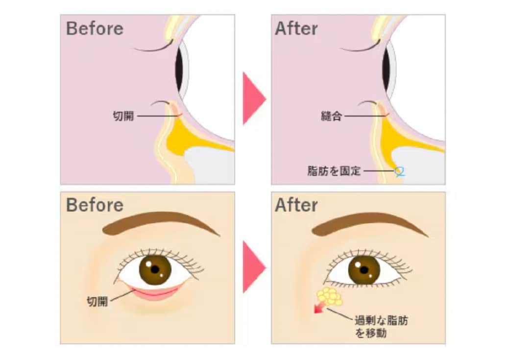 裏ハムラってどんな治療なの？