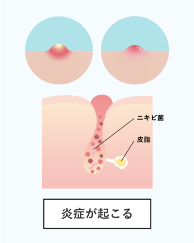 赤ニキビができる原因