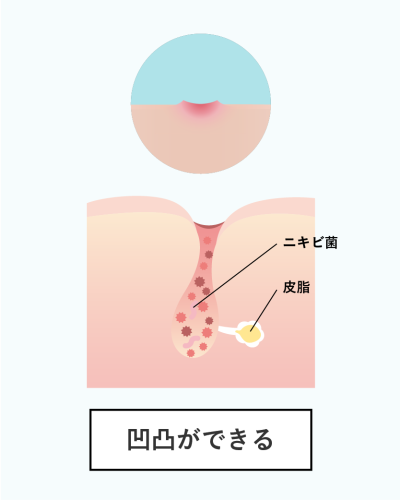 ニキビ跡ができる原因