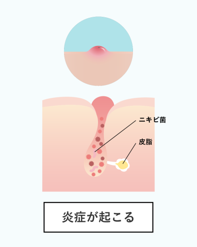 炎症ニキビができる原因