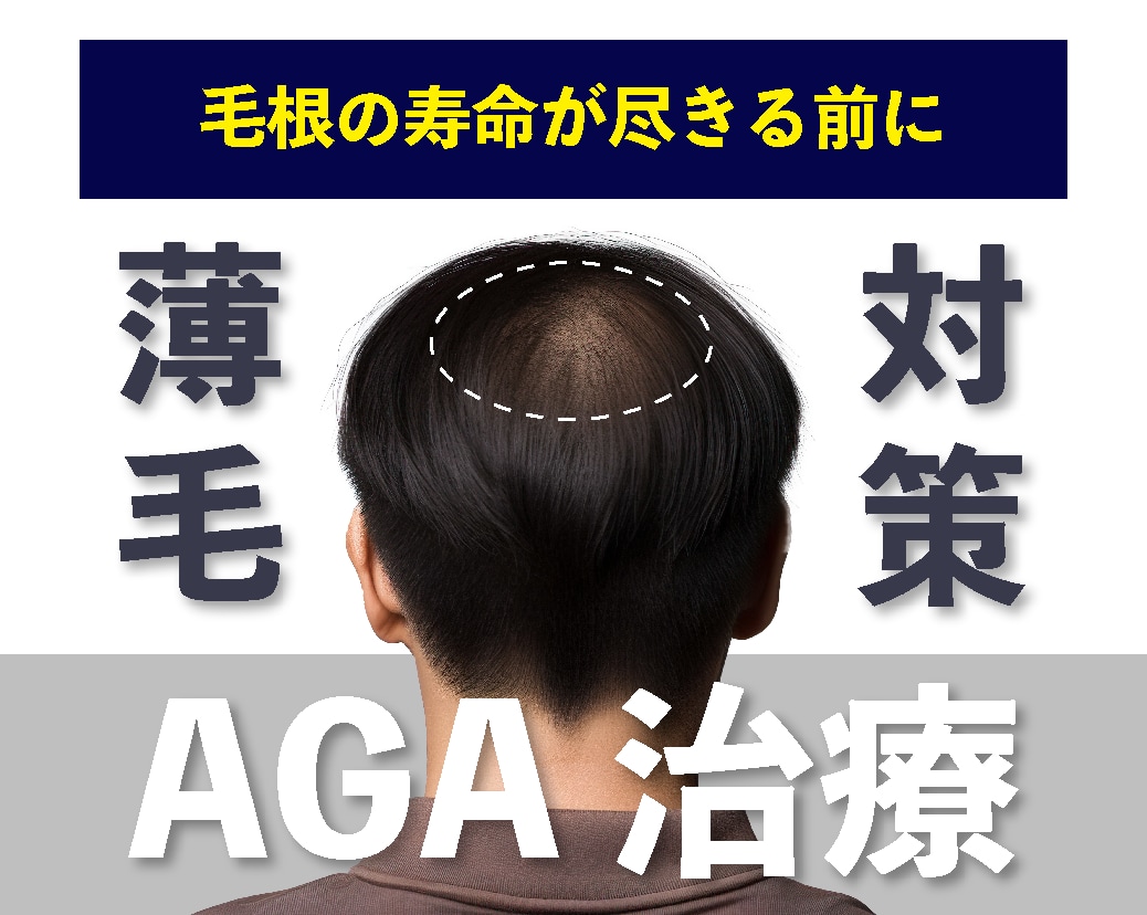 【早期薄毛対策】AGA治療をお考えの方へ！早く始めるべき理由とは？