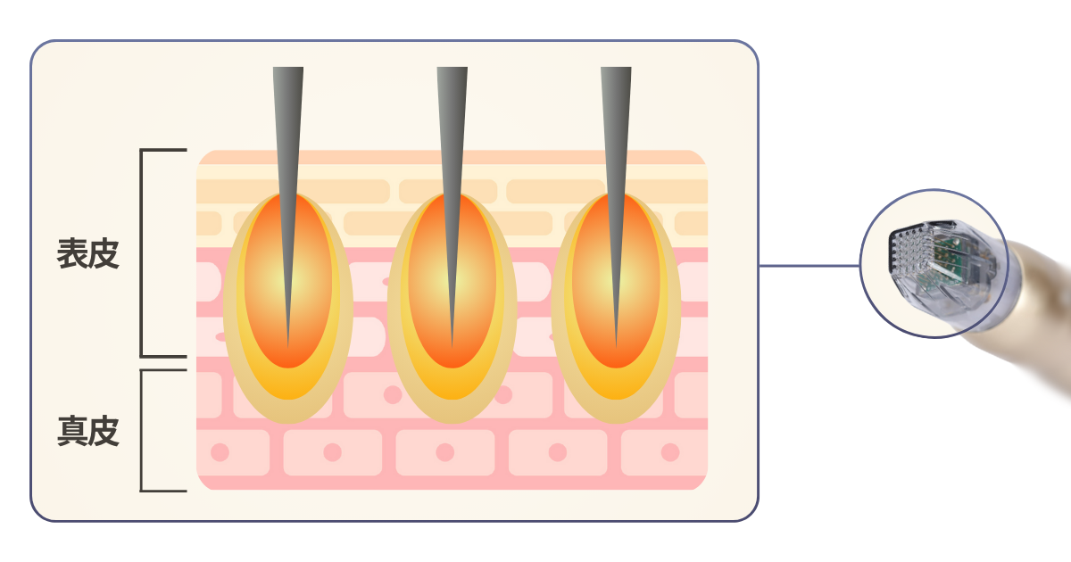 極細の針(マイクロニードル)+高周波で肌に働きかける