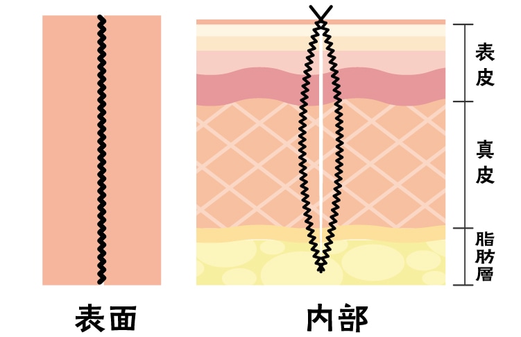 1.皮膚と皮膚は深い層まで位置を合わせて縫う