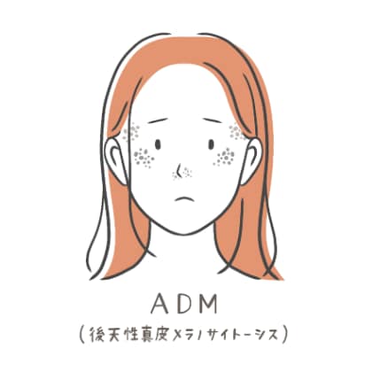 ADM(後天性真皮メラノサイトーシス)