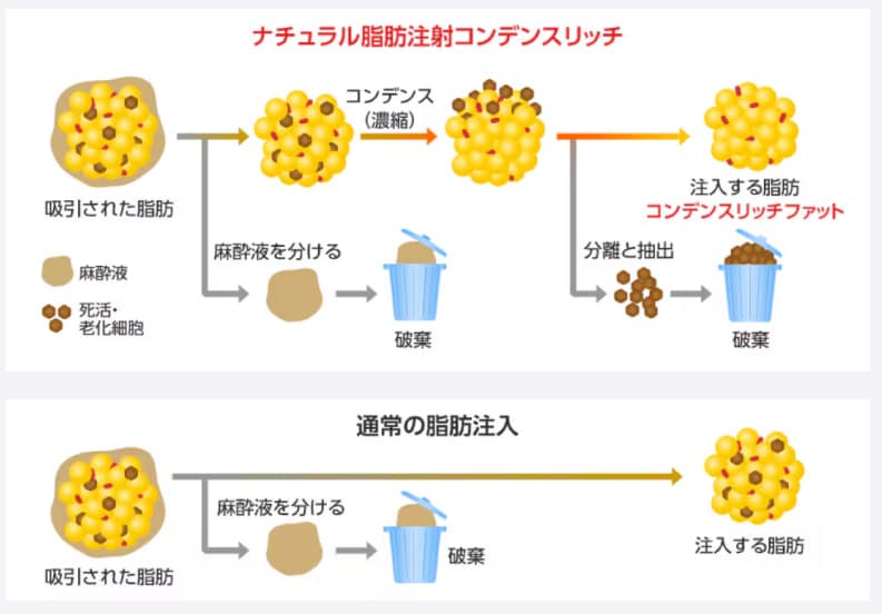 2つ目は脂肪注入