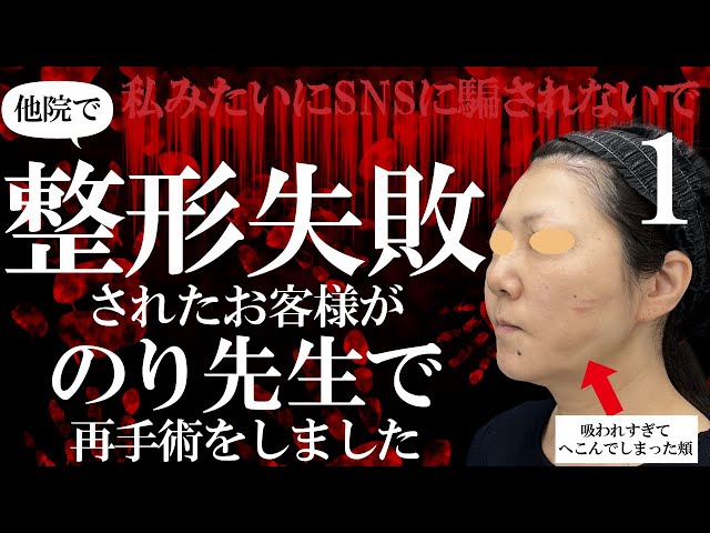 【他クリニックの脂肪吸引で失敗⁉】皆私と同じ思いをしないで！1年間悩んでようやく本物の先生に出会えました。【SBC川崎院】