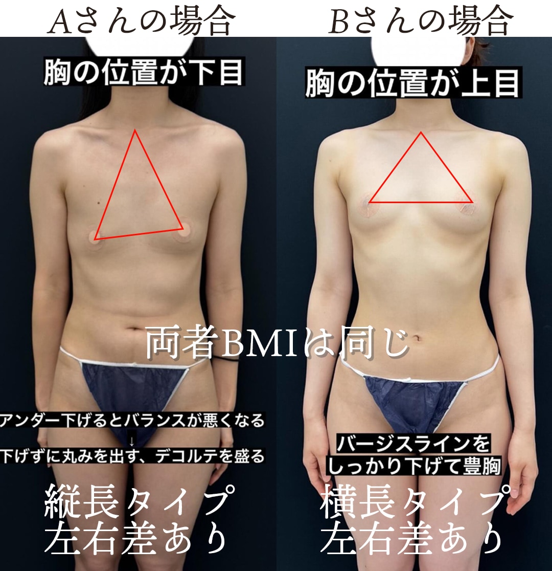 トライアングル別にみるそれぞれの胸の形。一人一人に合わせた脂肪の注入の方法紹介