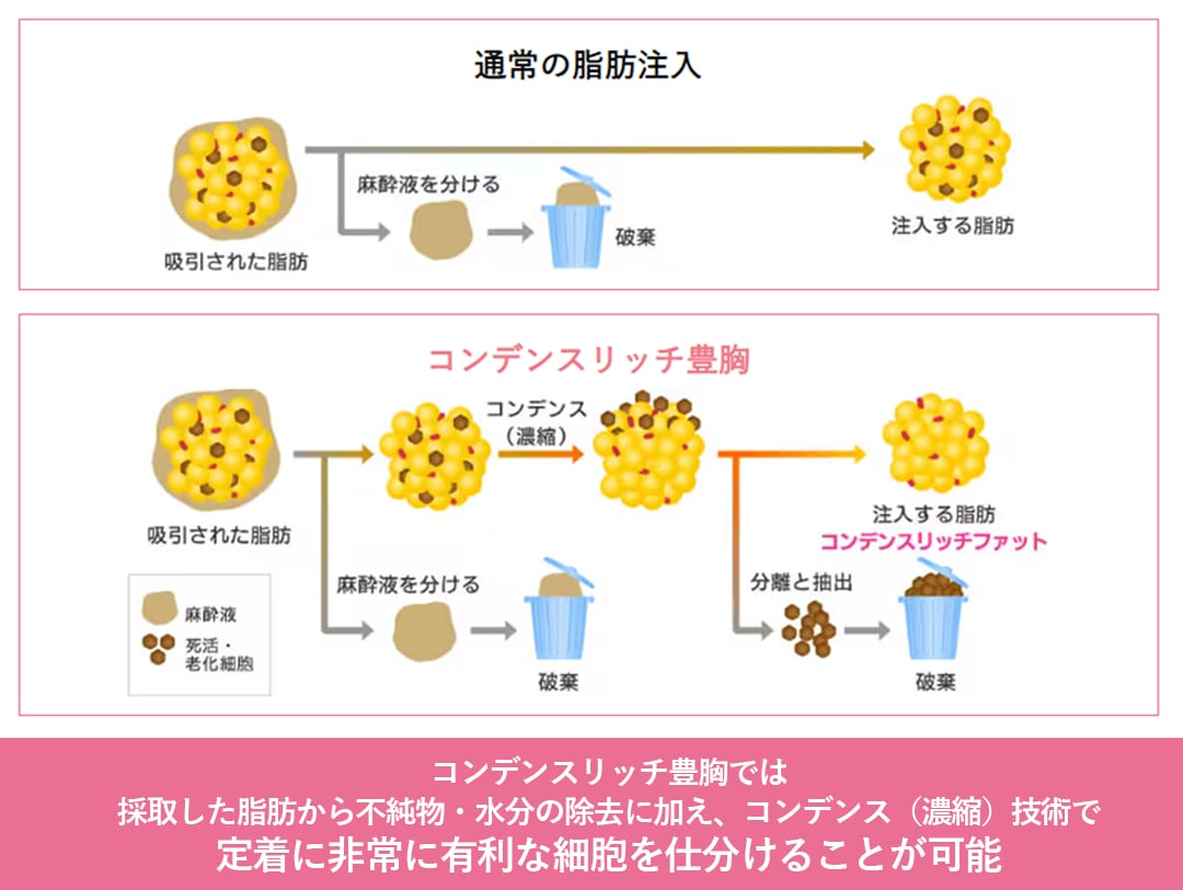 色々種類があってどれを選んでいいかわからない…定着率重視で行くならコンデンスリッチ豊胸が一番おすすめです♡