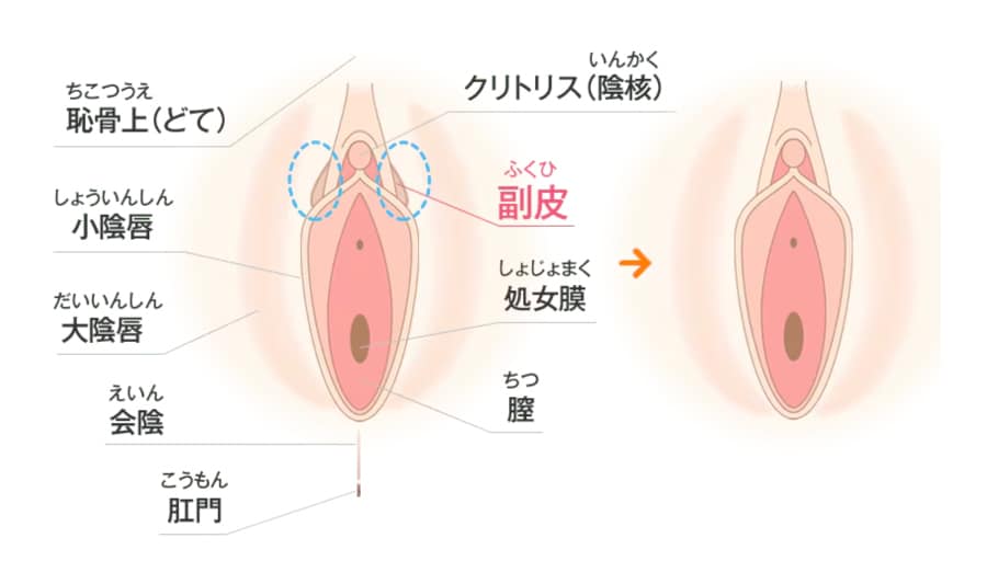 「副皮除去術」とは