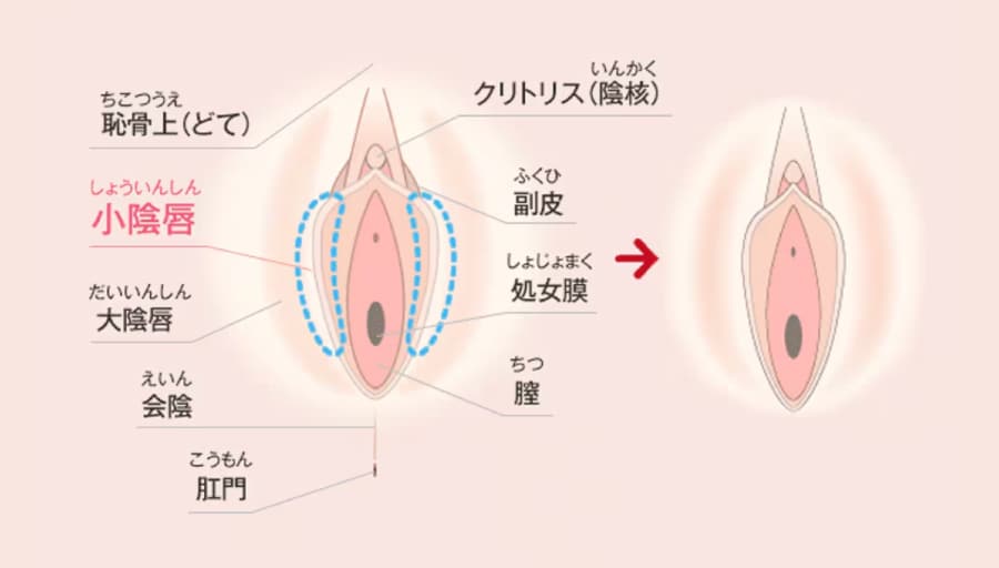 「小陰唇縮小術」とは