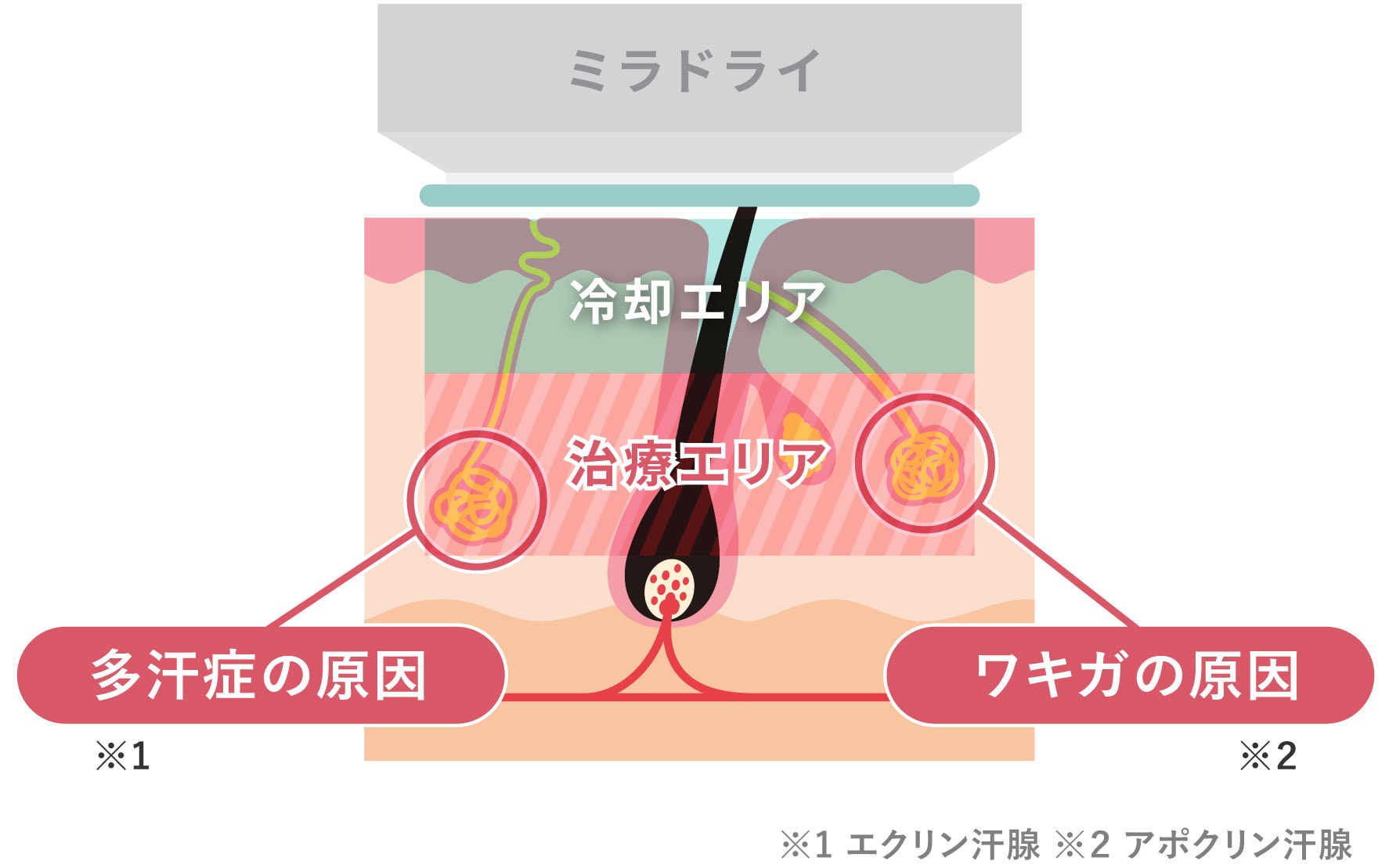 肌を切らないワキガ・多汗症治療