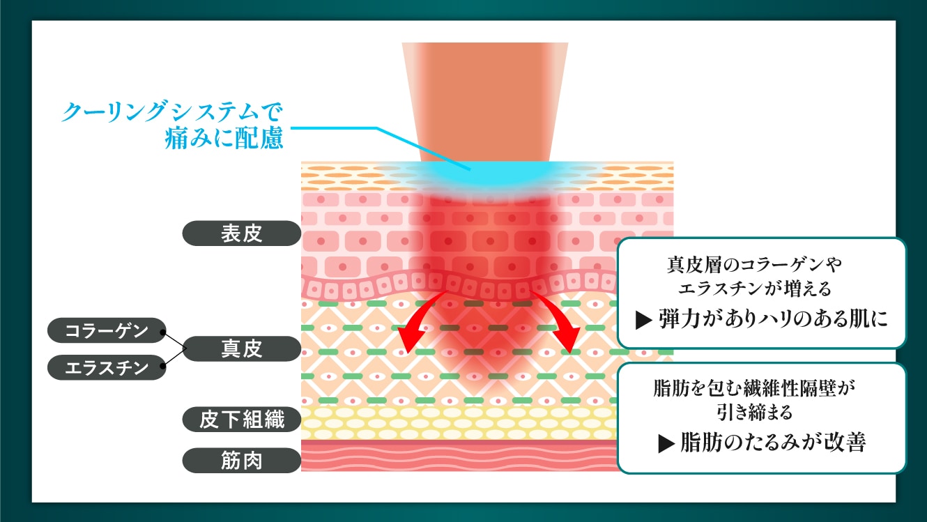 たるみが立体的に引き締まり、自然にタイトニング