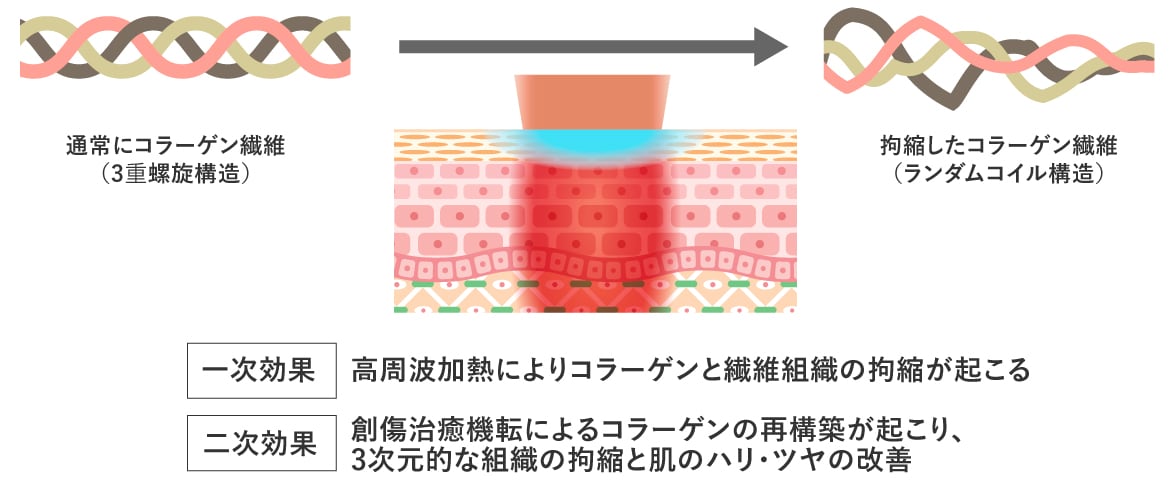 高出力の高周波で強力にたるみを引きしめ