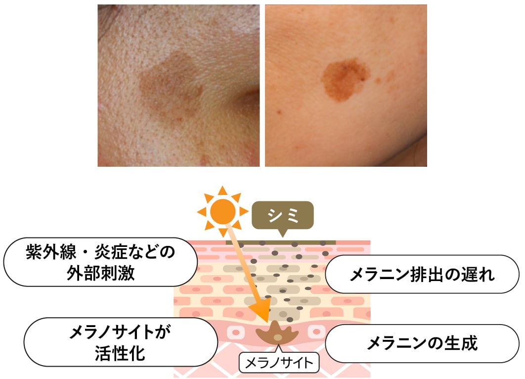 シミの悩みの60%を占める症状