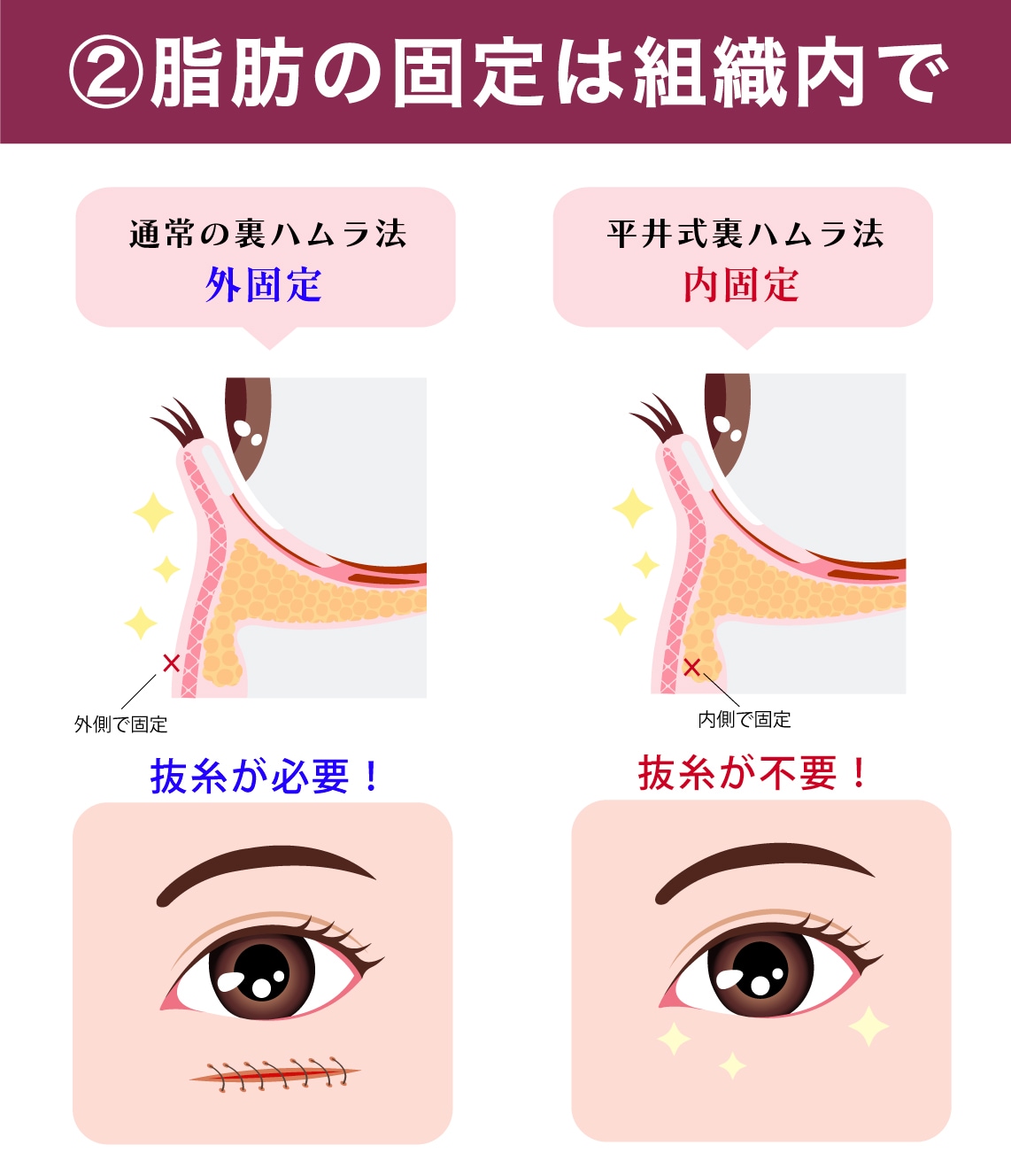 2.脂肪の固定は内固定