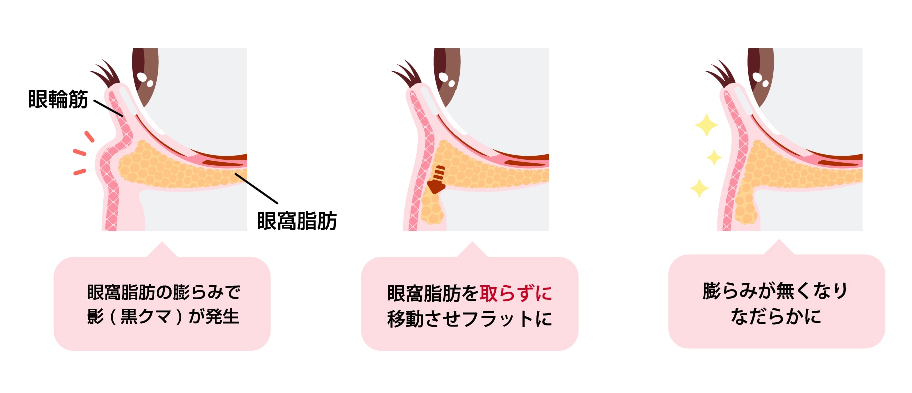 裏ハムラ法解説