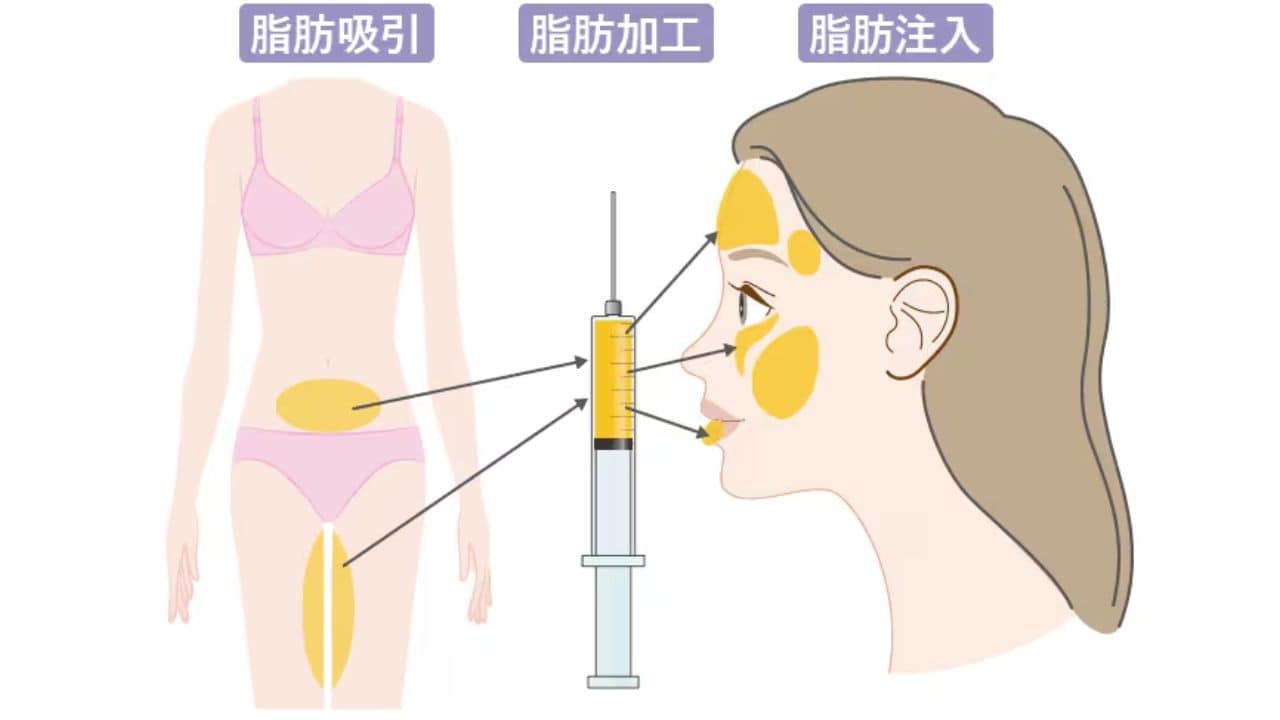 脂肪注入とは？