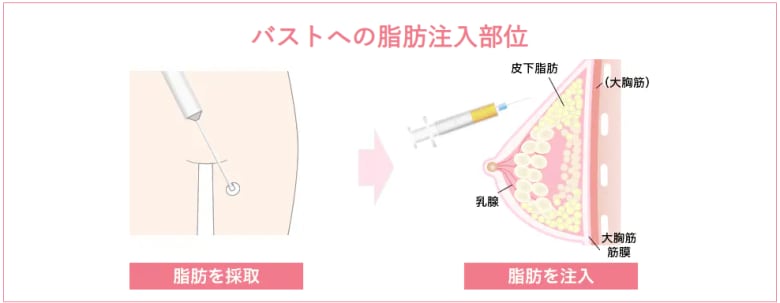 週末豊胸‐ピュアグラフト‐