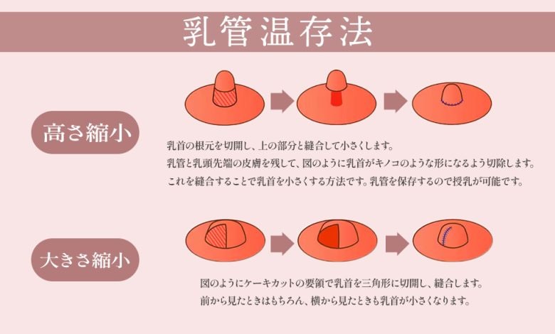 乳頭縮小術の流れ