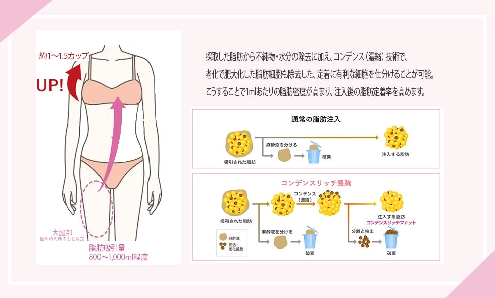 コンデンスリッチ脂肪注入豊胸