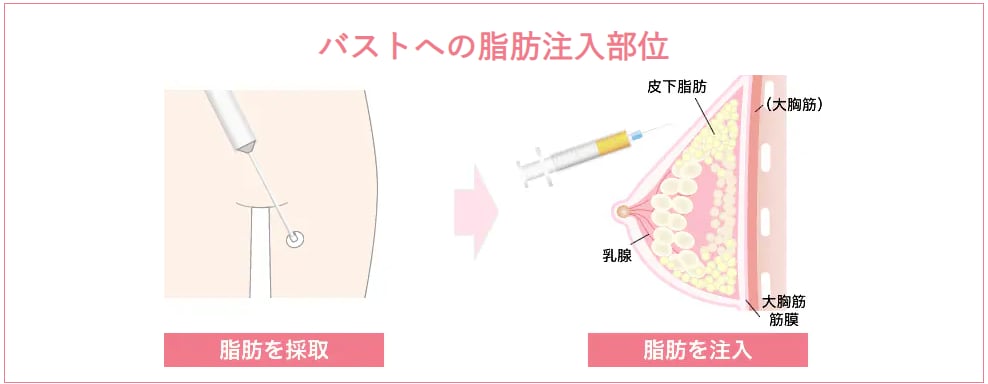 自身の脂肪を使ってバストアップ