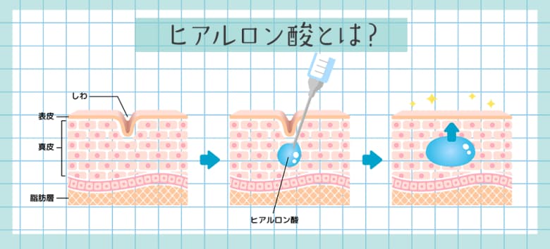 ヒアルロン酸注射は元々体内にある成分