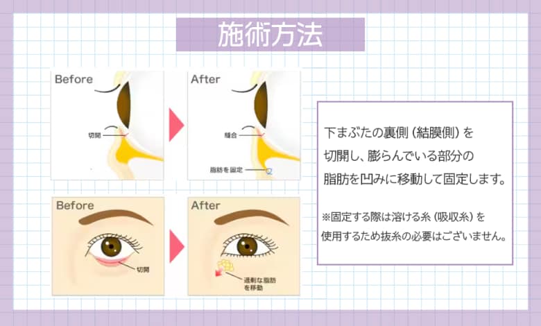 裏ハムラ法とは？