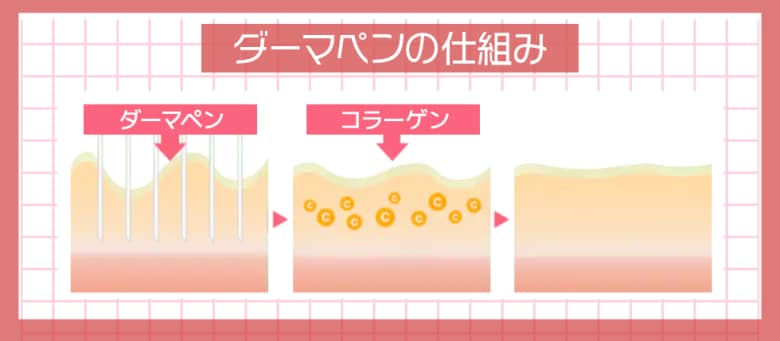 肌本来の回復力を活用し、ニキビ跡や毛穴など肌トラブル改善！