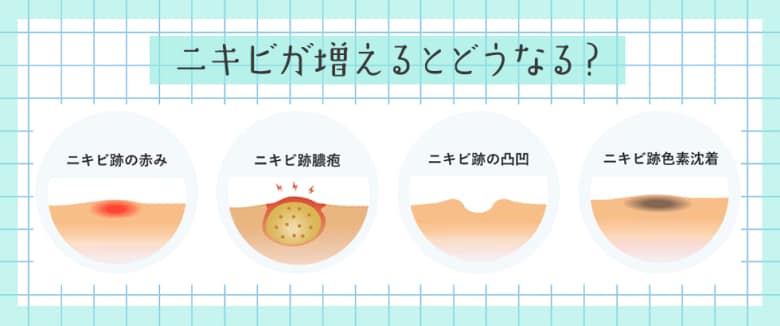 ニキビの放置はリスクがいっぱい