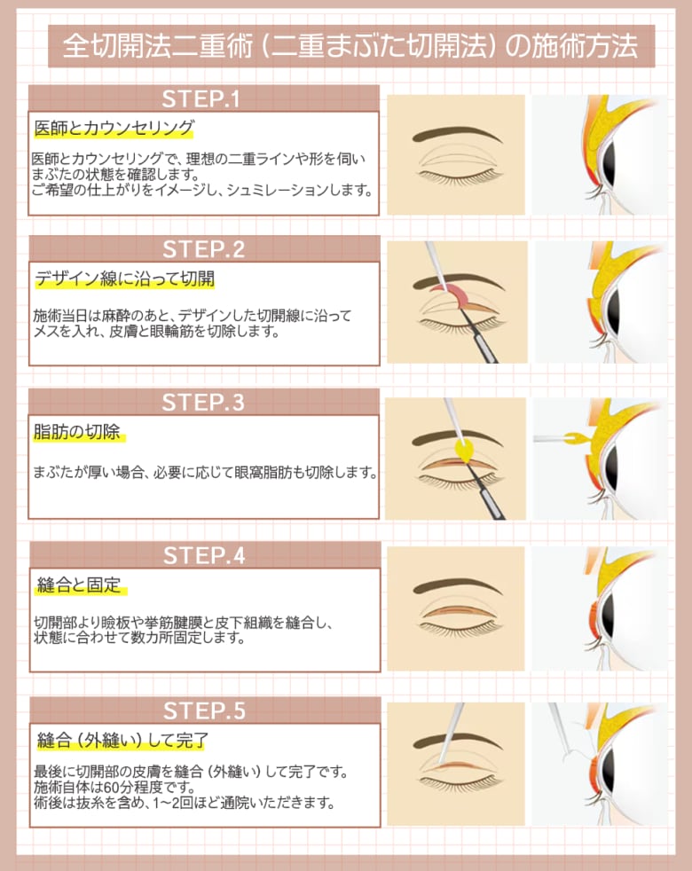 全切開法二重術（二重まぶた切開法）の施術方法は？