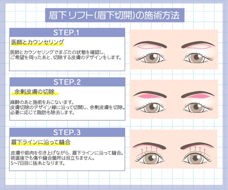 眉下リフト(眉下切開)はこんな施術！