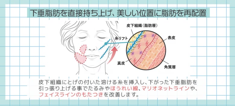 糸リフトの効果は今の悩みにも未来の予防にも◎