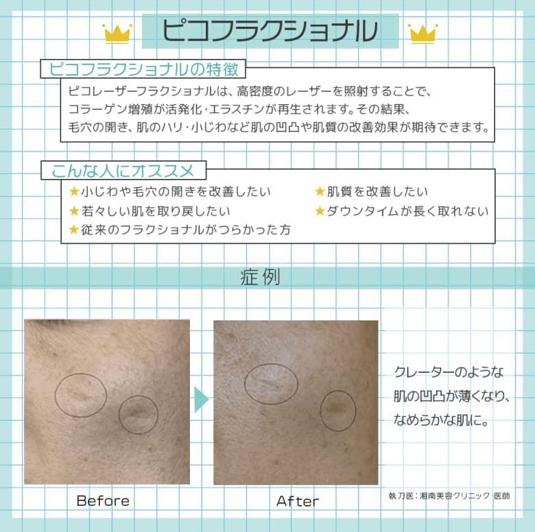 ピコフラクショナルの特徴と症例