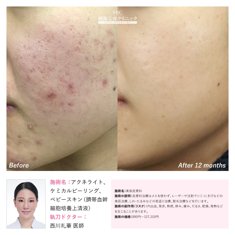 湘南美容クリニック 美容液 SBC ベビースキン 毛穴 くすみ しわ ニキビ