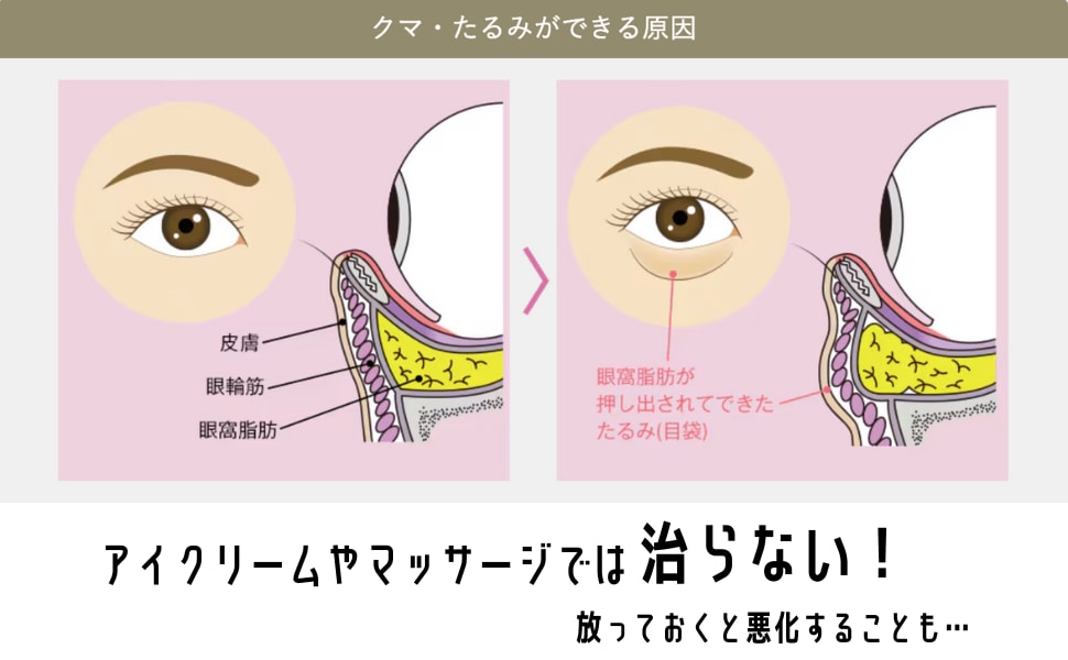 なんで【クマ】ができるの？