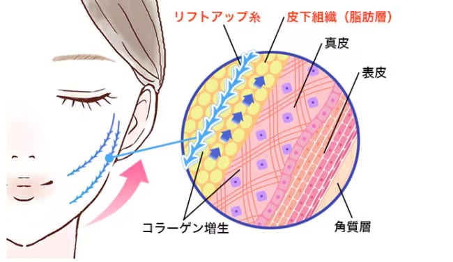 糸リフトとは