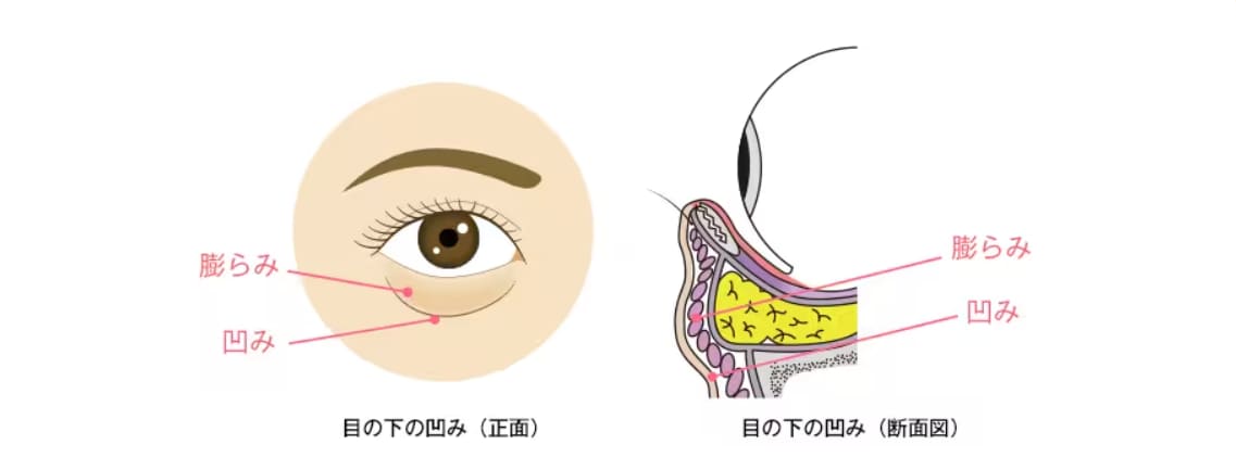 目の下のふくらみをとるだけじゃダメってほんと？