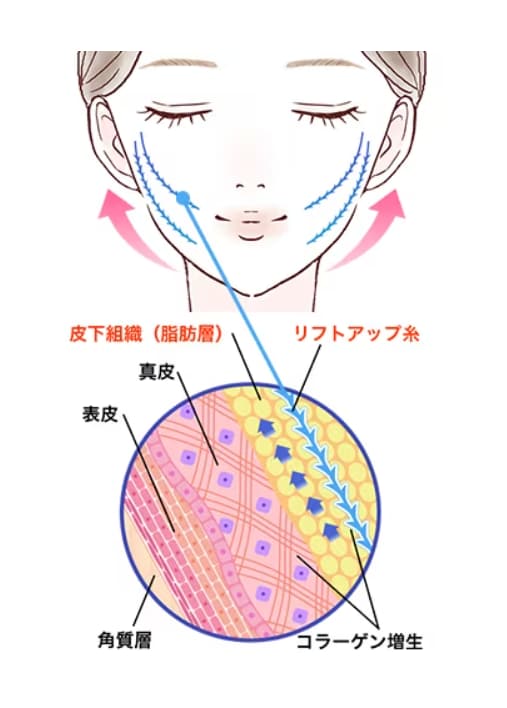 自然にバレずに効果を出したいなら糸リフト一択！