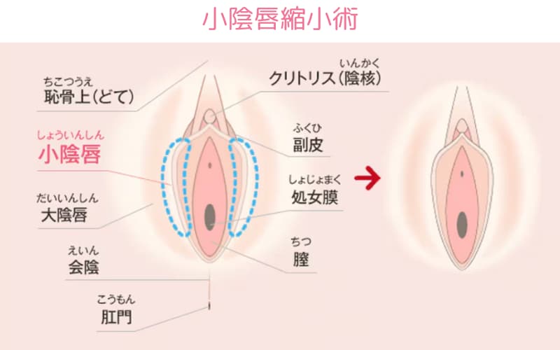 1.小陰唇縮小術(抜糸あり)