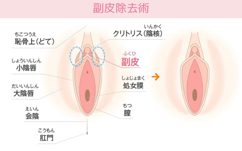 2.副皮除去術(抜糸あり)