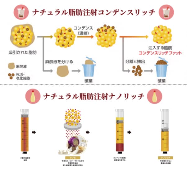 2種類の脂肪注入