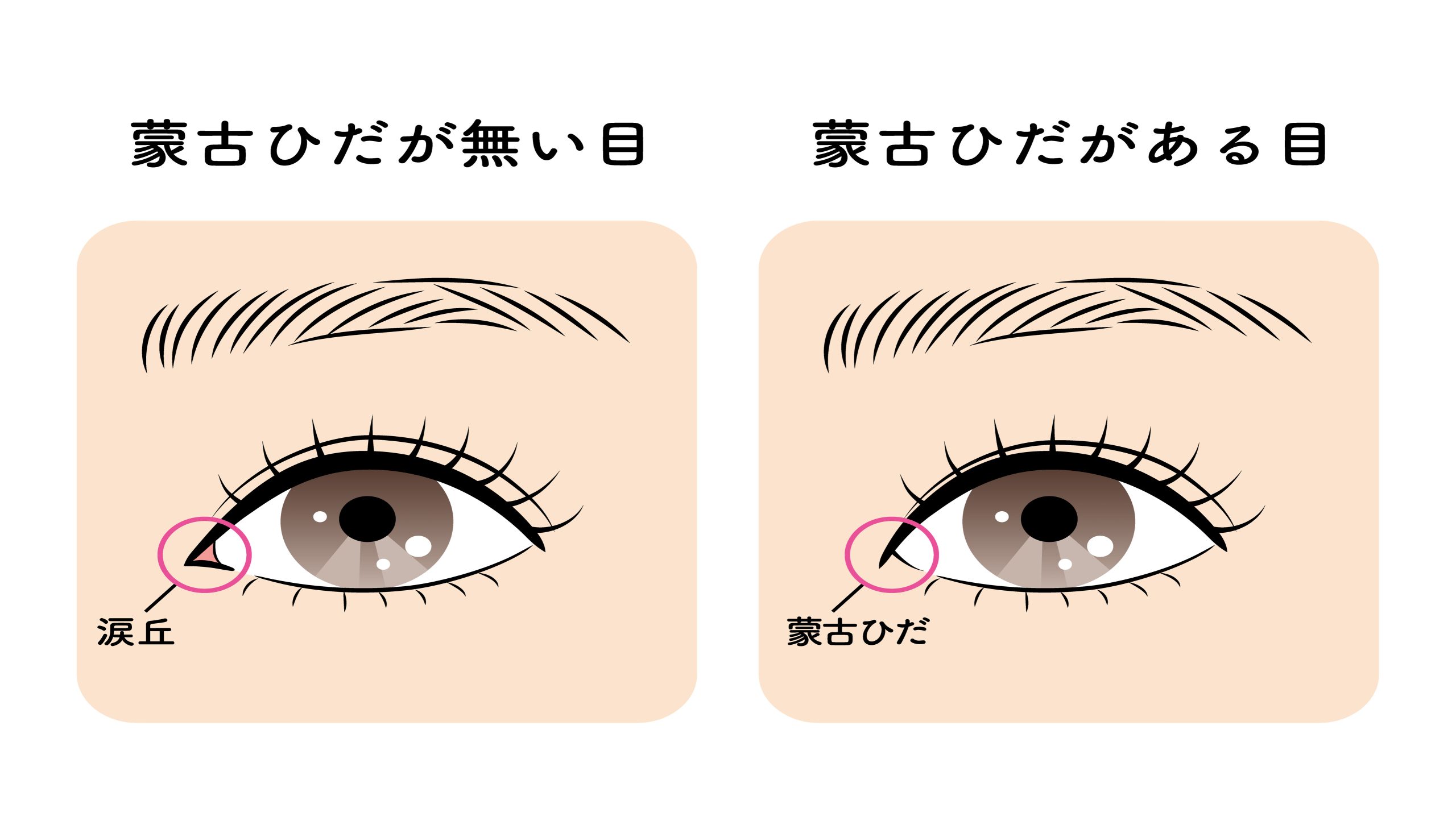 目頭切開とは