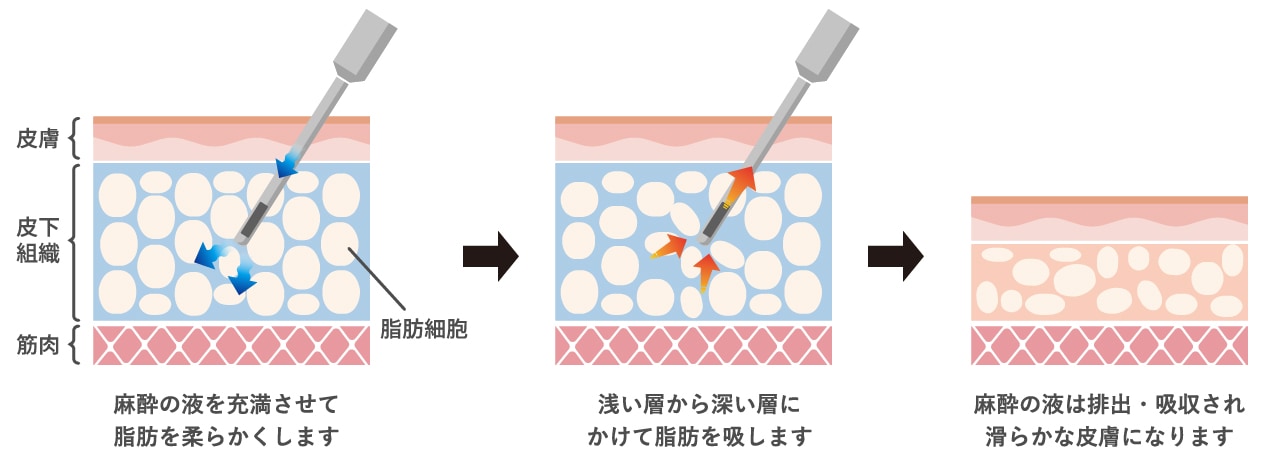 美ボディ脂肪吸引