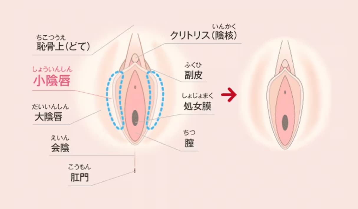 熊本にお住いの女性必見！】婦人科形成でデリケートゾーンの悩みを解消する方法 - 熊本院