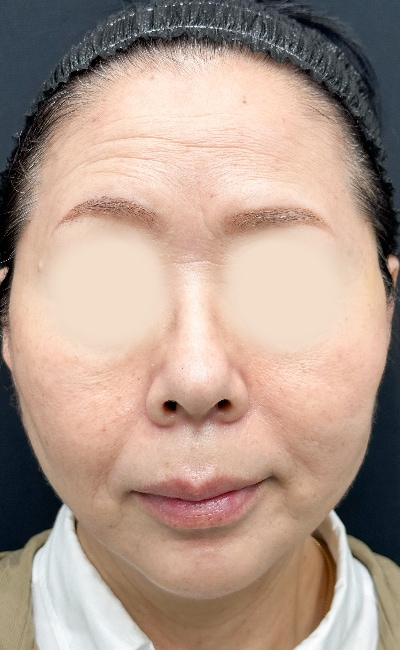 糸リフト60代女性の術後の症例写真