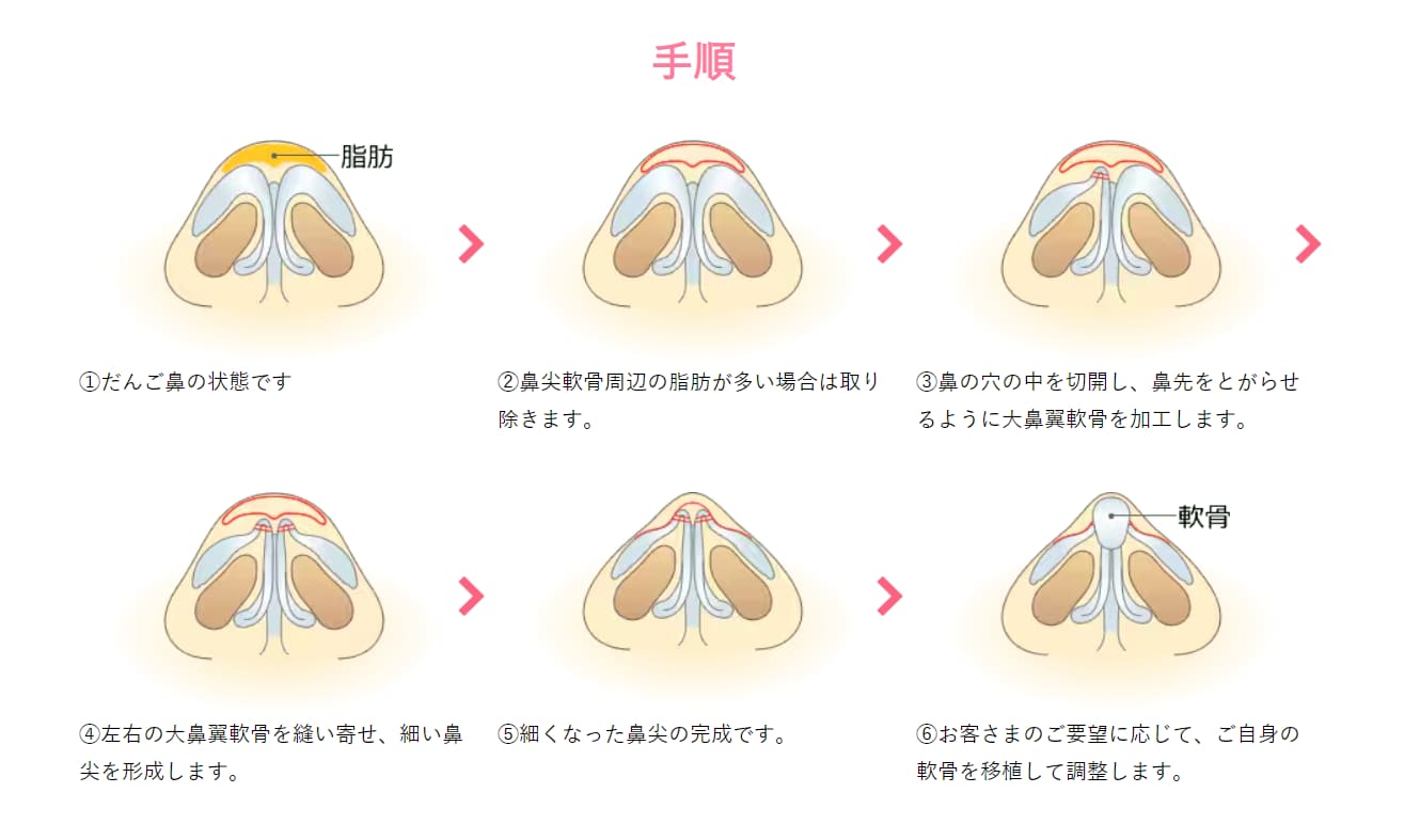 鼻尖形成(だんご鼻解消術)