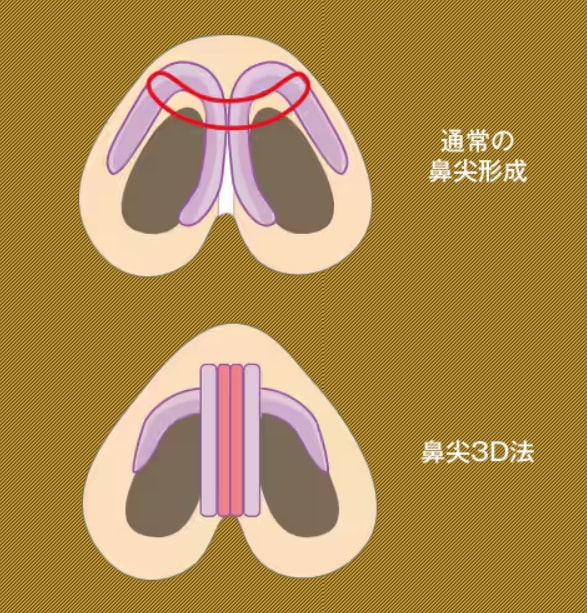 鼻尖形成術3D法