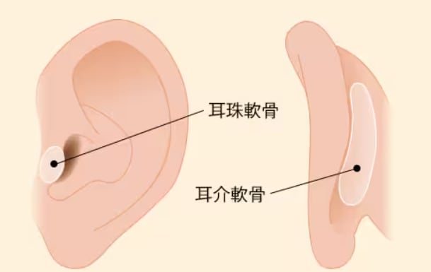 鼻尖部軟骨移植(鼻への耳軟骨移植)