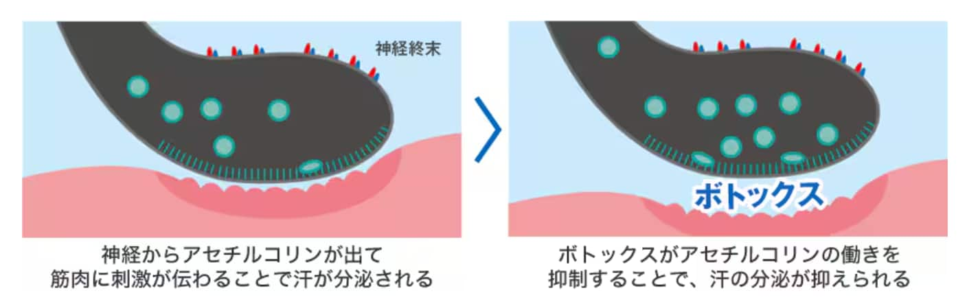 汗止め注射：ボトックス