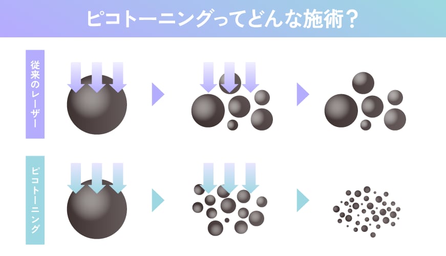 従来のレーザーとはここが違う！